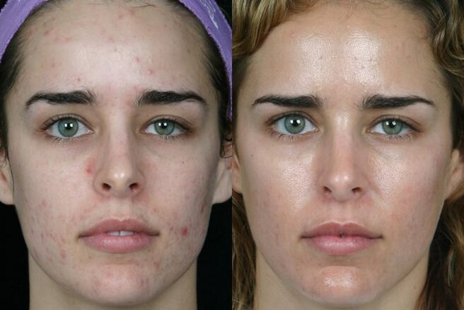 Laser broyant la peau du visage avant et après